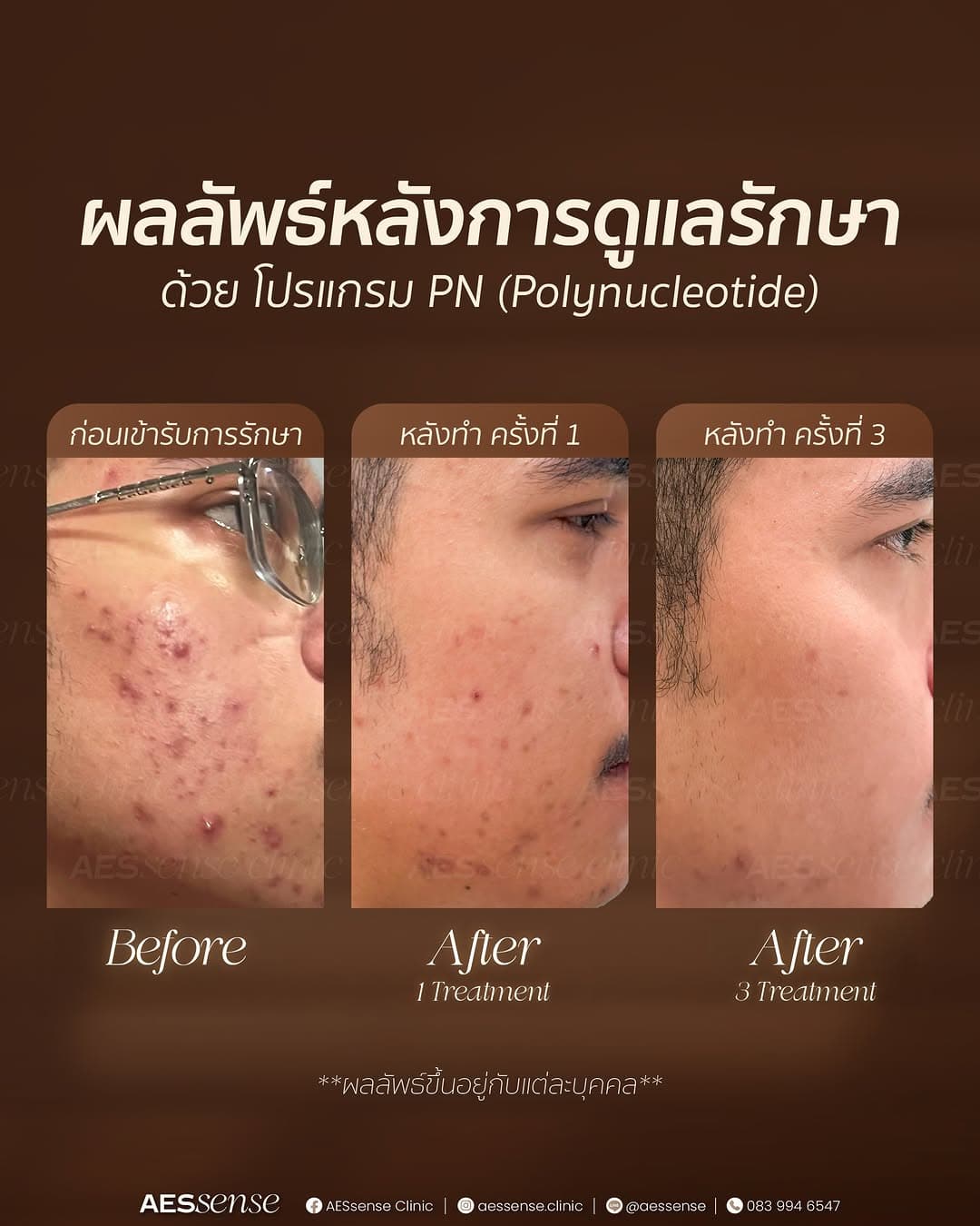 Treating acne by rebuilding a stronger skin foundation